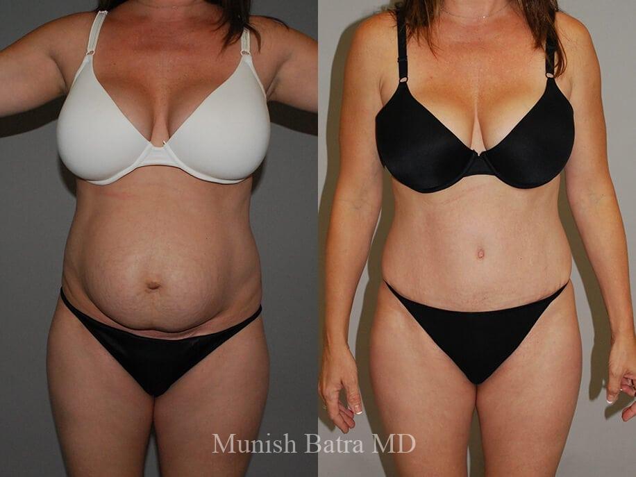 Asian 600cc breast augmentation before after Redhead