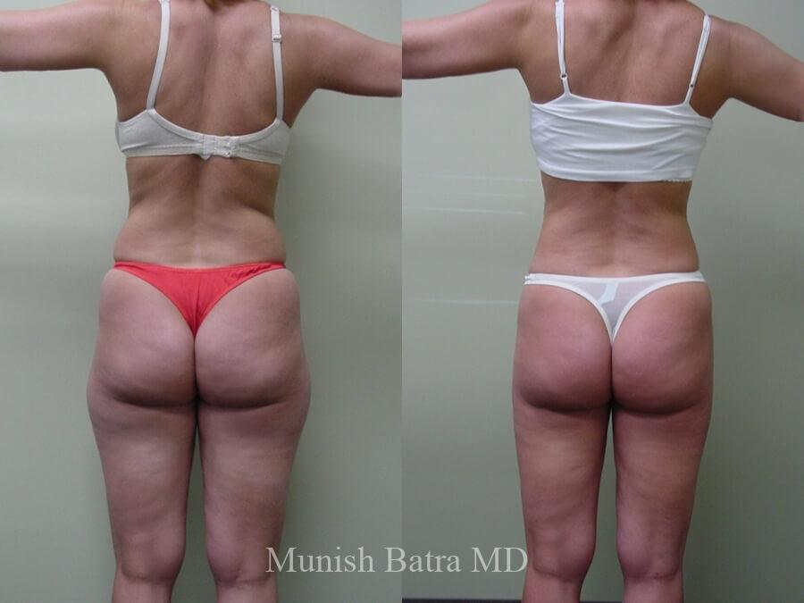 Liposuction Before and After Photo Gallery, San Diego, CA