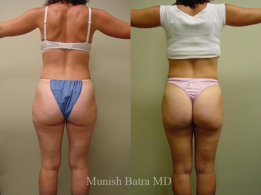 Liposuction Before & After Gallery: Patient 12