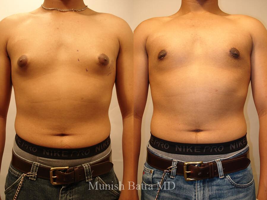 Male Liposuction Gallery