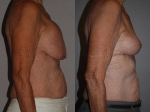 Before and After Complex Breast Patient 36 Photos