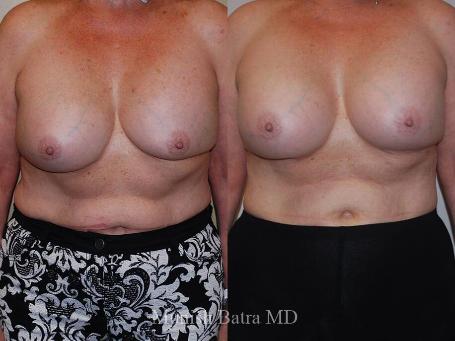 Before and After Complex Breast Patient 36 Photos