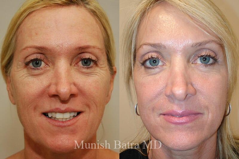 Before & After Fraxel Laser Photos - Coastal Plastic Surgeons