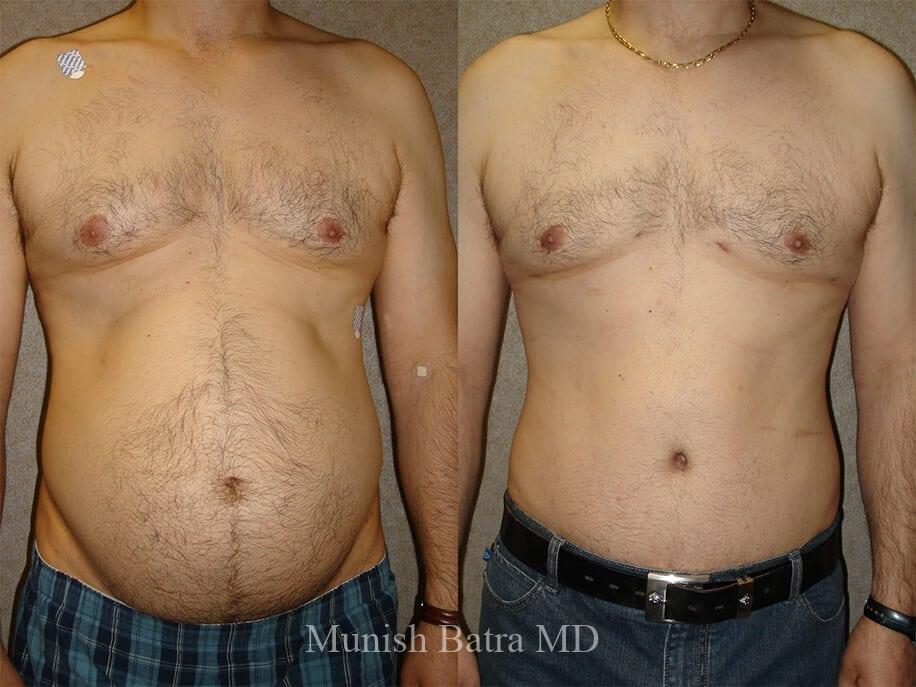 Male Liposuction, San Diego