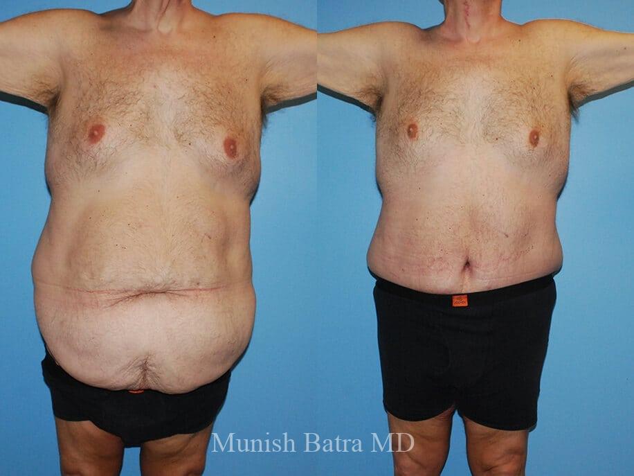 Patient #6023 Male Tummy Tuck (abdominoplasty) Before and After